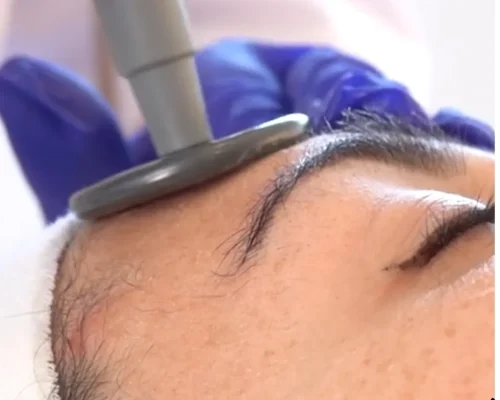 Fotorejuvenecimiento